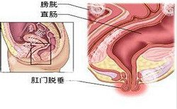 南寧治療脫肛哪家醫(yī)院好？南寧脫肛治療多少錢？